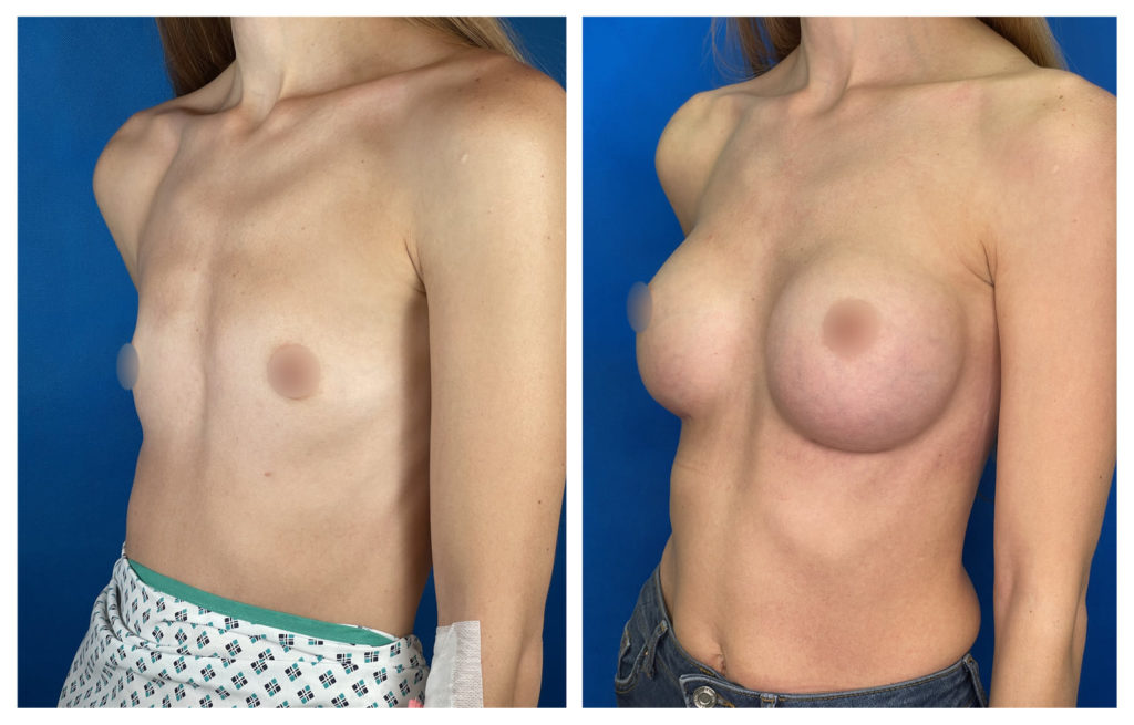PODCAST Krása & Zdraví: Zvětšení prsou (Augmentace)